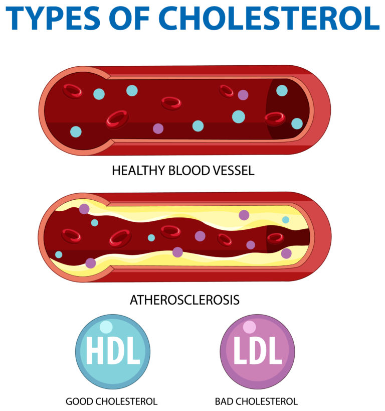 lipid profile panel