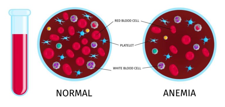 sickle cell disease